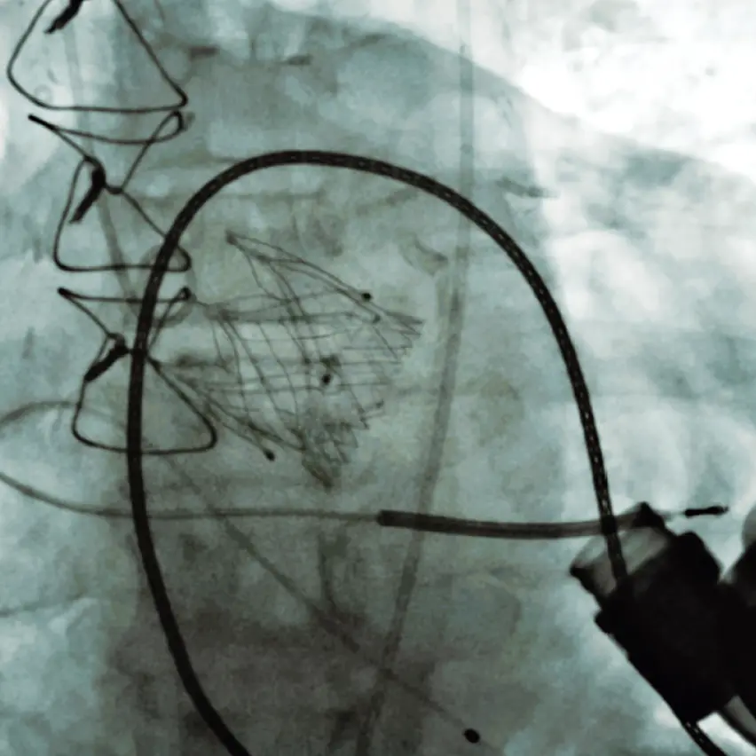 Trilogy valve in patient with LVAD under fluoroscopy
