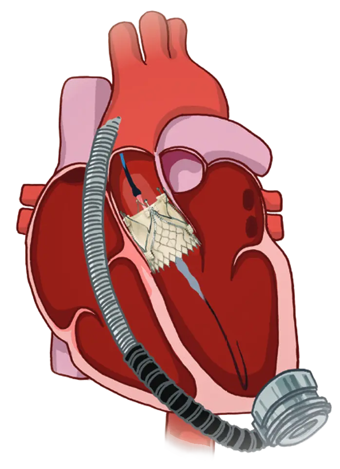 Trilogy valve in patient with LVAD under fluoroscopy