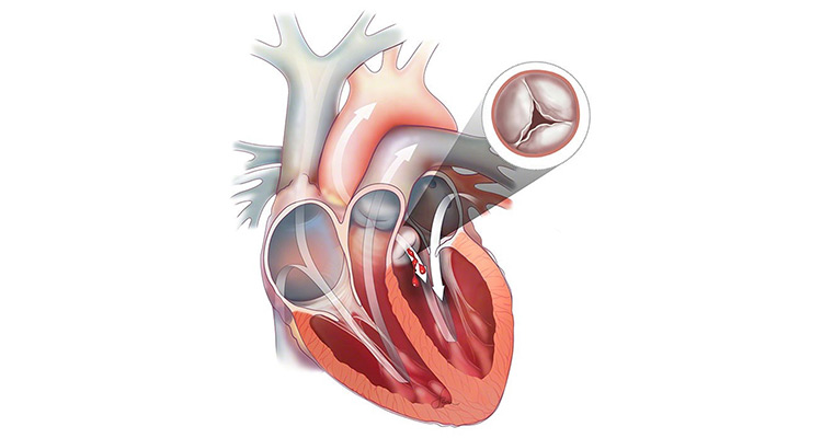 aortic regurgitation diagram